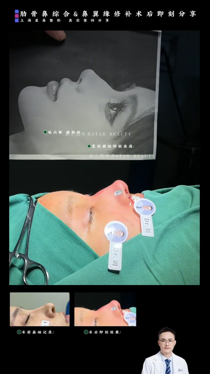 肋骨鼻综合 + 鼻翼缘修补 术后即刻案例：一台"鼻尖支撑 + 鼻翼缘复位"的联合方案