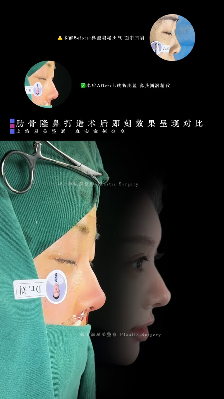 肋骨隆鼻打造术后即刻效果呈现对比