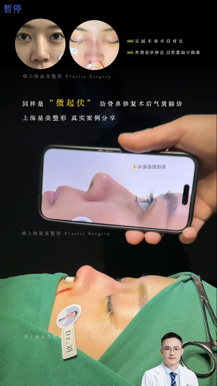 微起伏肋骨鼻修复