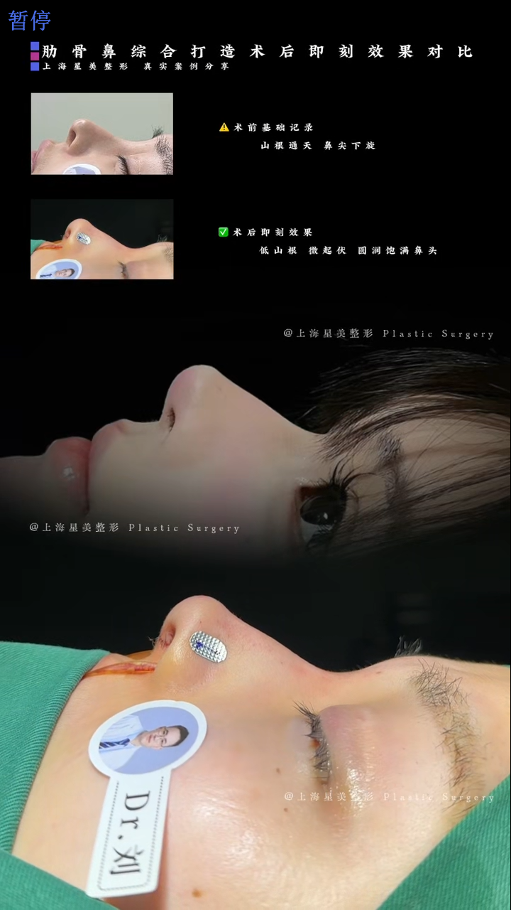 肋骨鼻综合术后即刻对比